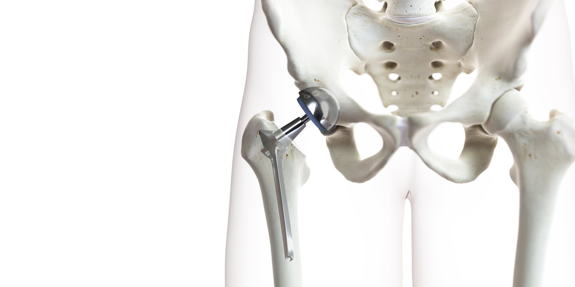 Hip Replacement Components | Seco Tools